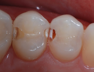 Damaged Teeth 6