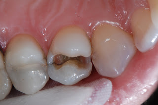 Damaged Teeth 5