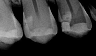 Damaged Teeth X - Ray