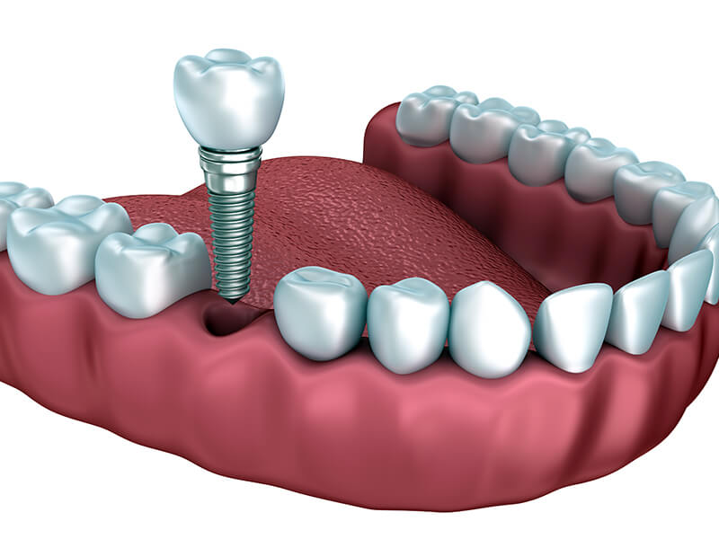 Dental Implant Dentist in Milford MA Area